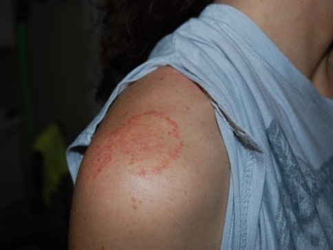 Infekce plísní Trichophyton benhamiae na člověku/foto: Naďa Malátová