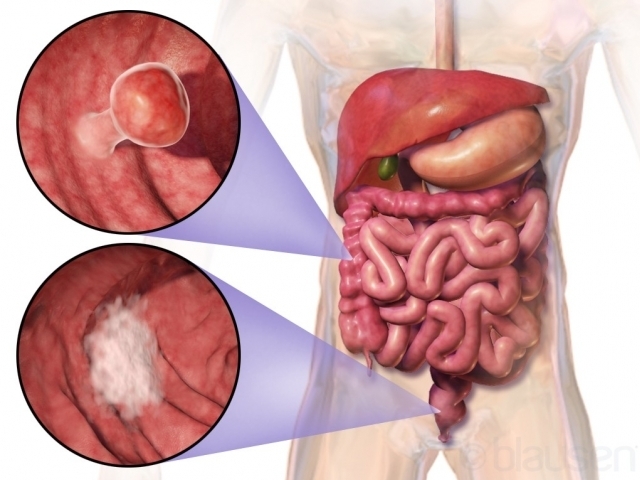 Kolorektální karcinom, autor: Blausen Medical Communications, Inc. Kolorektální karcinom, autor: Blausen Medical Communications, Inc.