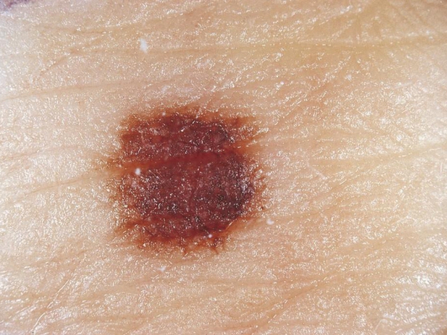 Evropský den melanomu má za cíl prevenci kožních nádorů, foto Česká akademie dermatovenerologie